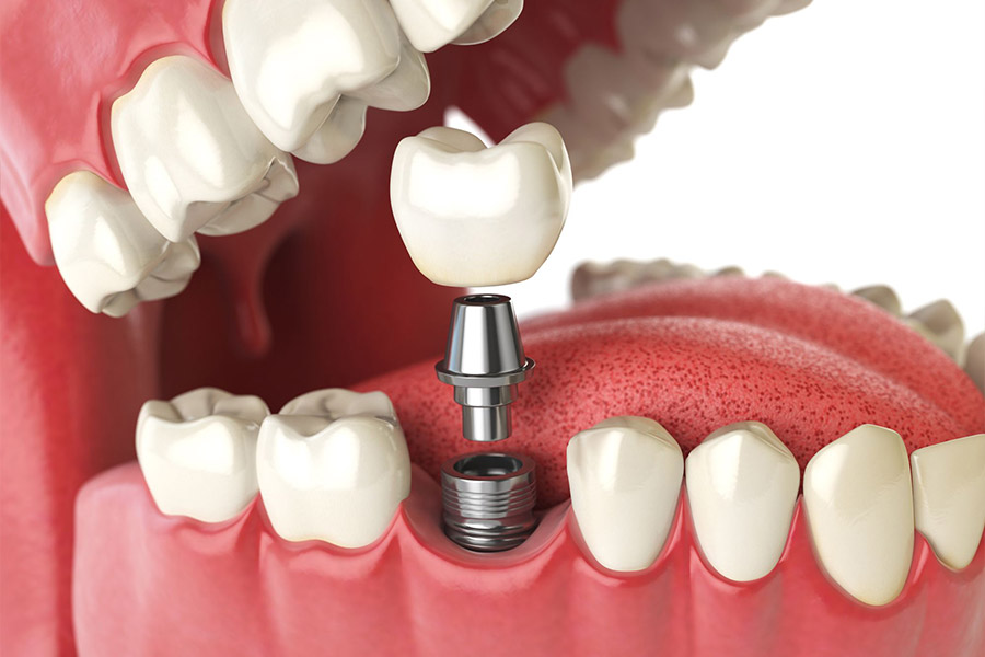 Зъбни импланти - дентална имплантология