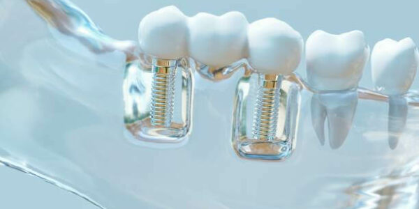 Поставяне на зъбни импланти - имплантологично лечение